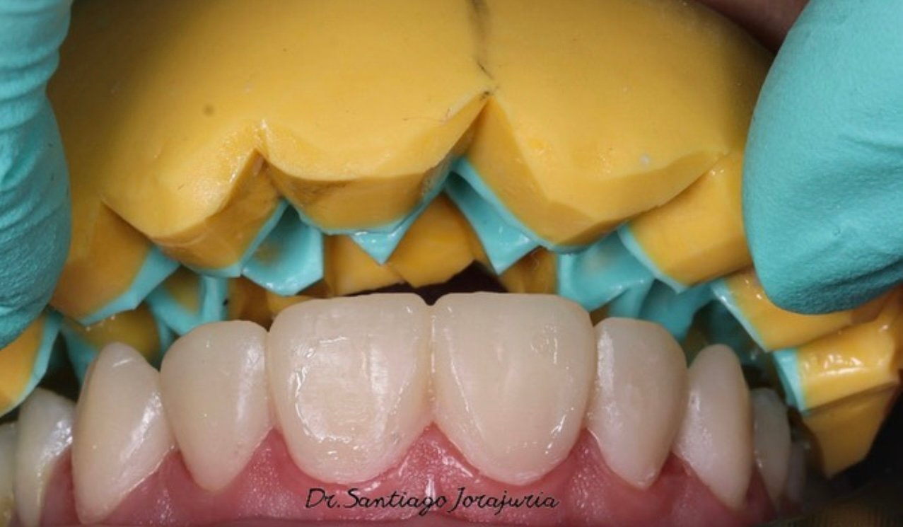 Simulación digital de sonrisa